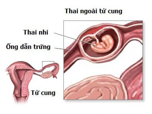 Khi nào phẫu thuật được sử dụng để điều trị thai ngoài tử cung?