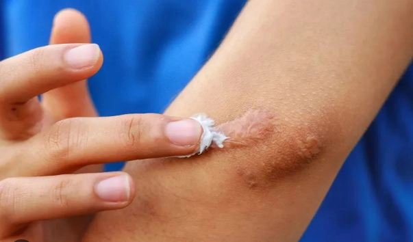 Khi nào thì bôi thuốc chống sẹo vào vết thương?