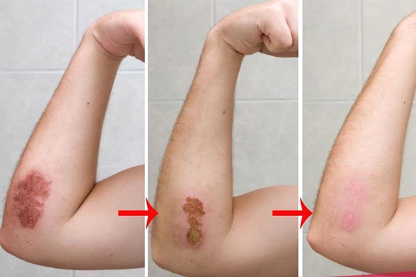 Khi nào thì dùng thuốc chống sẹo?