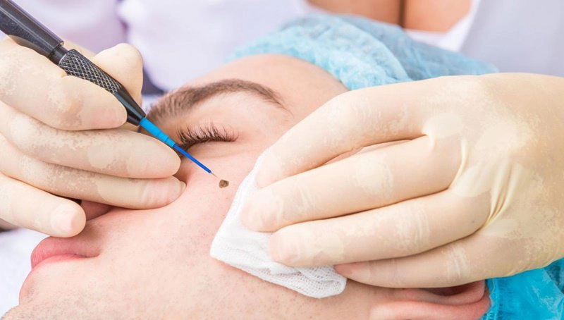 Kinh nghiệm chăm sóc da sau khi tẩy nốt ruồi
