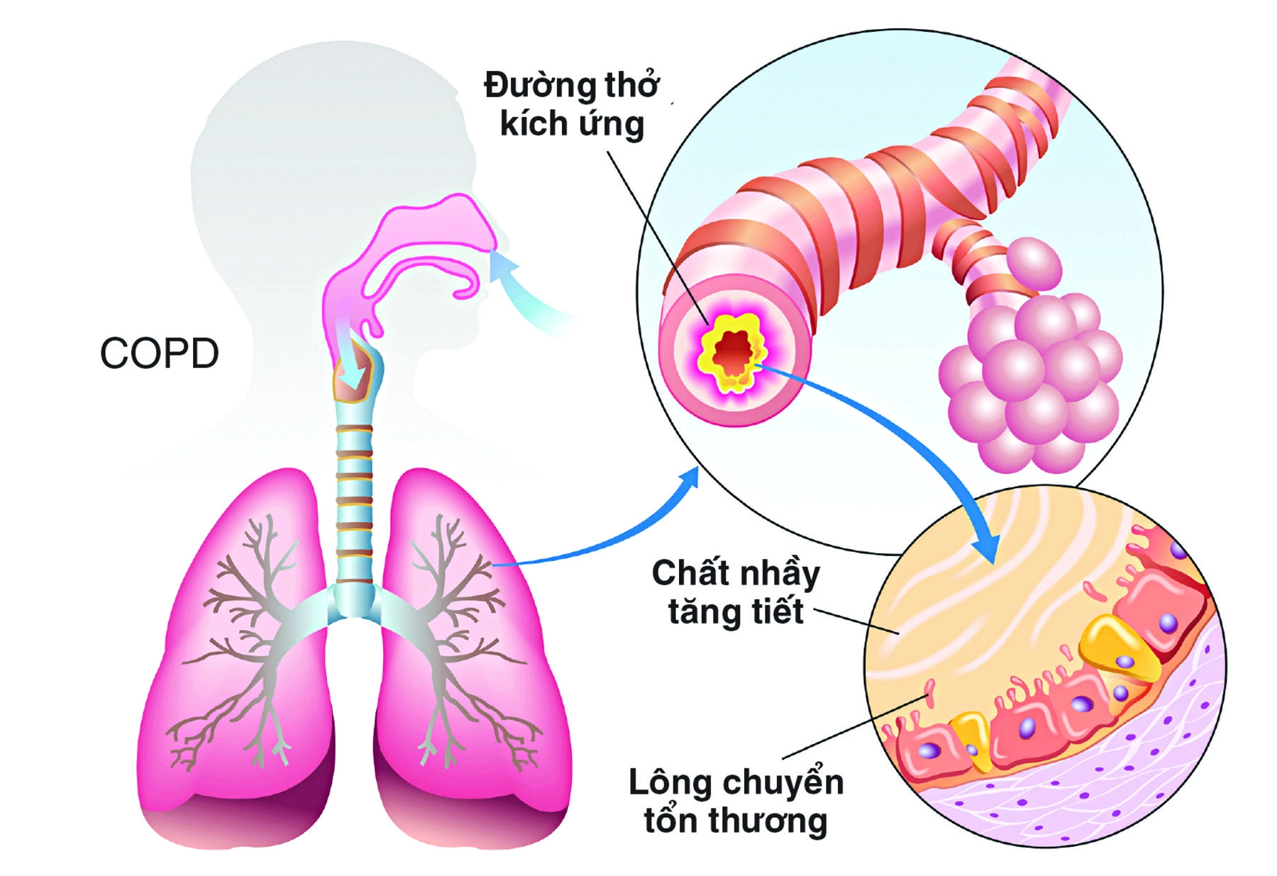 Kỳ 1: Bệnh phổi tắc nghẽn mãn tính có phải là hen suyễn do thuốc lá?