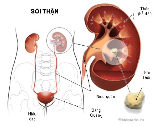 Kỹ thuật nào đánh giá tình trạng tiến triển của sỏi thận?