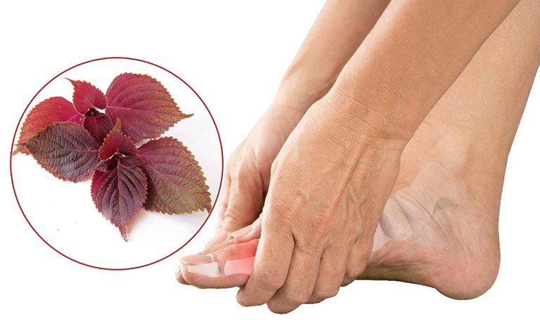 Lá tía tô chữa bệnh gút được không?