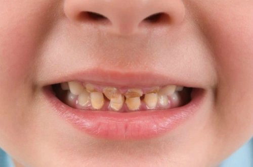 Làm gì khi bé bị mòn răng sữa?