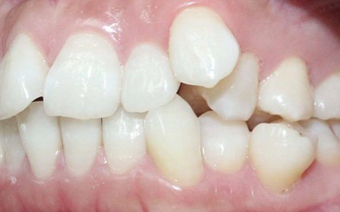 Làm gì khi bị xô lệch hàm răng?