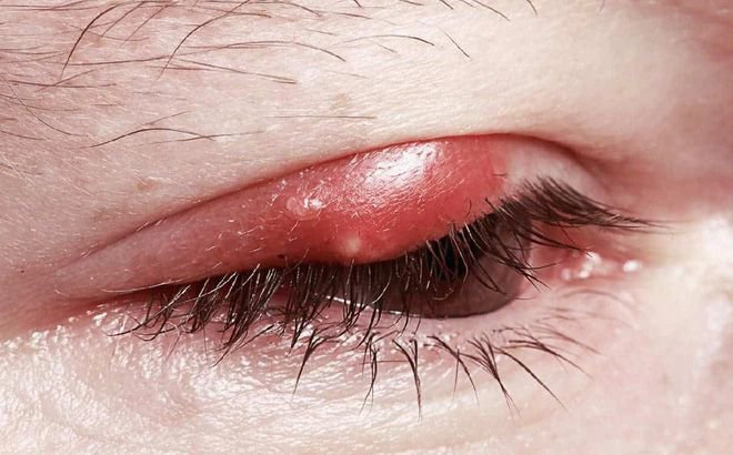 Làm gì khi mắt bị lẹo?