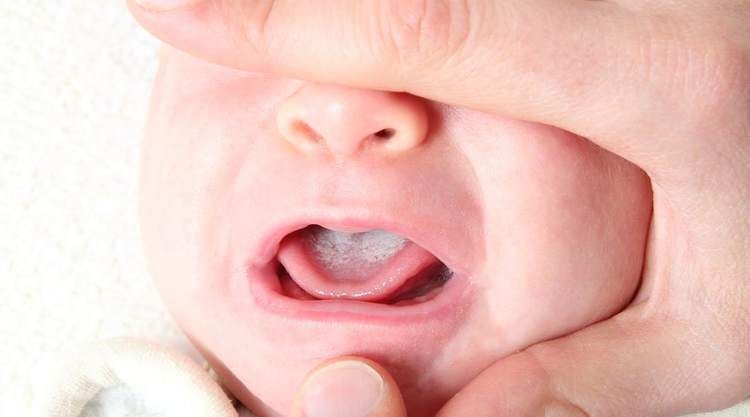 Làm gì khi trẻ bị đẹn?