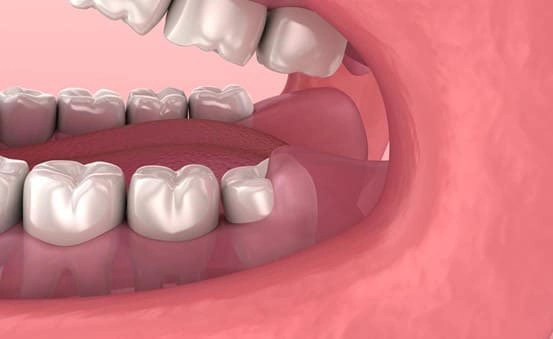 Làm gì với lợi thừa ở răng hàm?