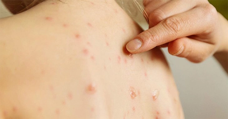 Làm sao để không bị lây thủy đậu?
