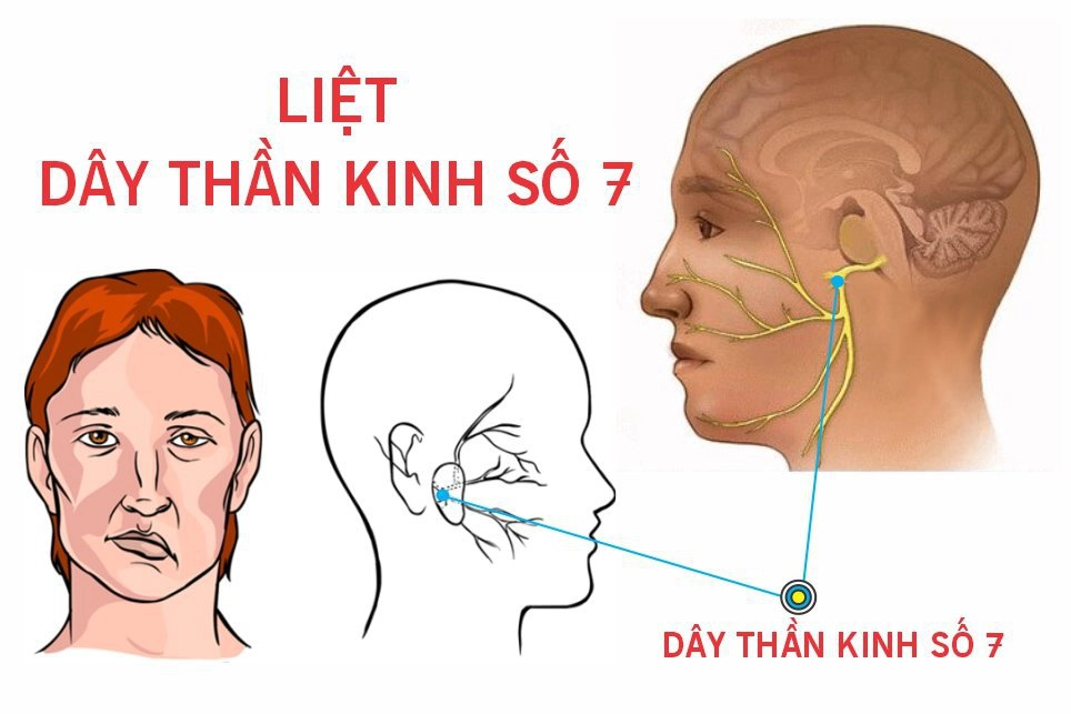 Liệt dây thần kinh số 7 sau chấn thương sọ não có chữa được không?