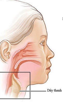 Liệt dây thanh quản T sau phẫu thuật cắt thực quản phải làm sao?