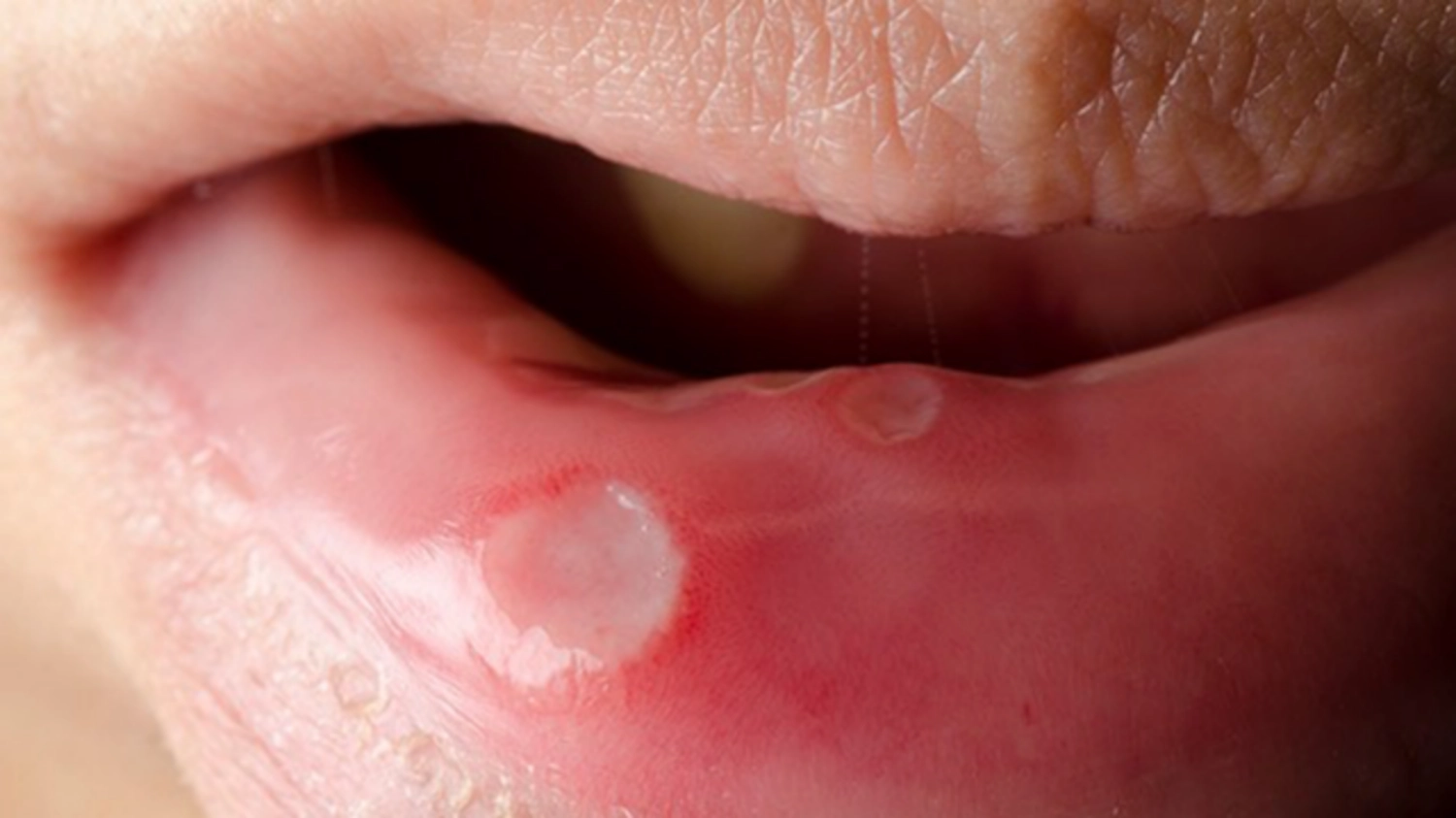 Loét miệng ở bệnh nhân HIV