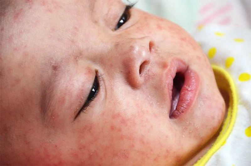 Lưu ý chăm sóc da cho bé khi bị sởi