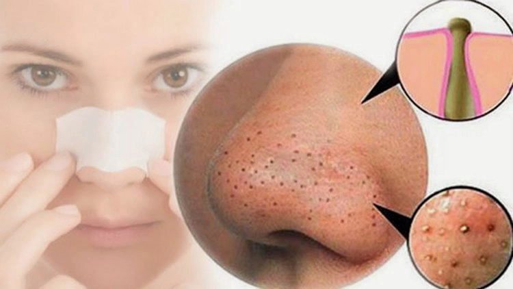 Lưu ý khi dùng thuốc trị mụn đầu đen ở mũi