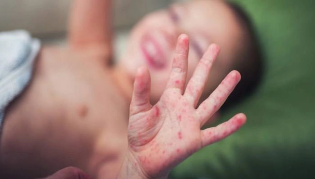 Lưu ý sử dụng thuốc bôi ngoài da cho người bị tay chân miệng