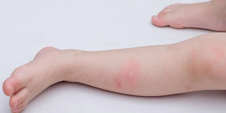 Lý do khiến trẻ bị nổi mẩn đỏ như muỗi đốt