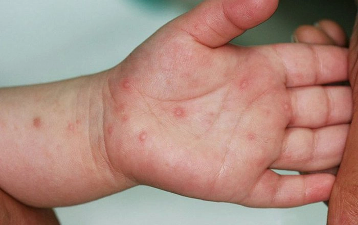 Mã ICD bệnh tay chân miệng và đặc điểm sinh lý của bệnh