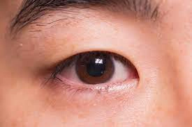 Mắt đỏ kèm mụn nhọt trong mắt dấu hiệu bệnh gì?