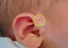 Mổ rò luân nhĩ biến chứng áp xe có gây tê không?