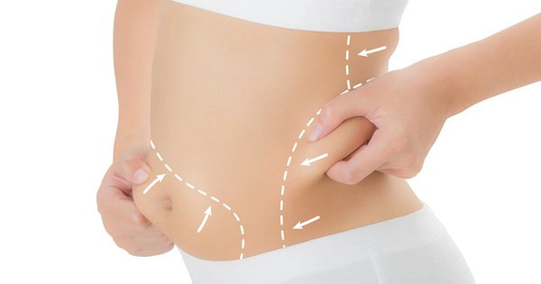 Mỡ thừa có tích tụ trở lại sau khi hút mỡ bụng không?