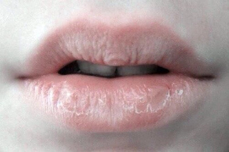 Môi khô bong da lâu năm điều trị thế nào?