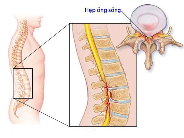 Một số kiến thức cơ bản về hẹp ống sống thắt lưng
