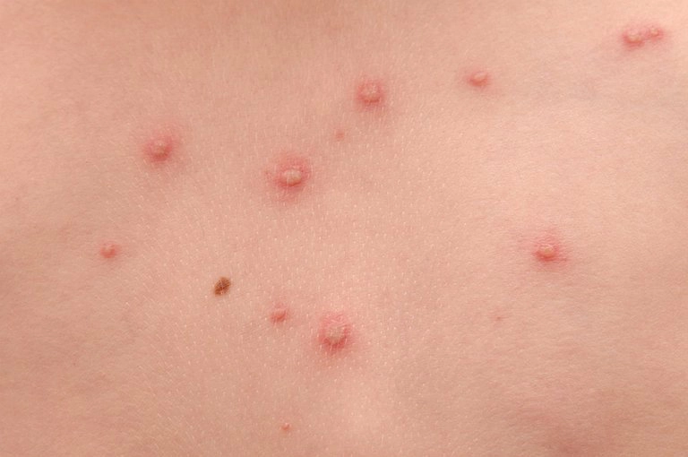 Mụn nước: Nguyên nhân và cách điều trị