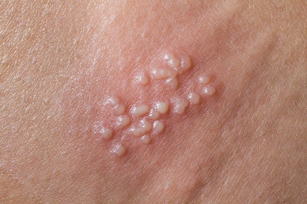 Mụn rộp sinh dục: Chớ coi thường!