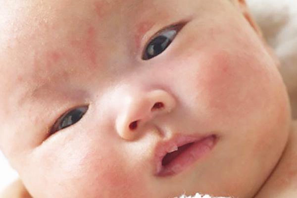 Mụn sữa ở trẻ sơ sinh có tự biến mất không?