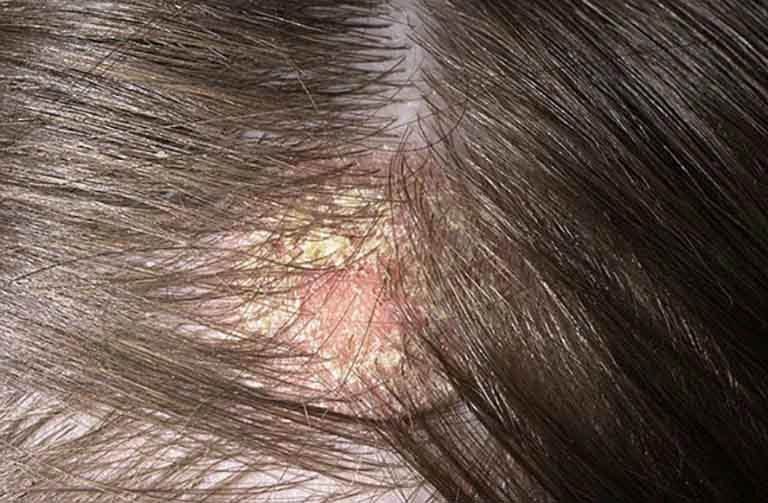 Nấm đầu kèm ngứa da đầu nên bôi thuốc gì?