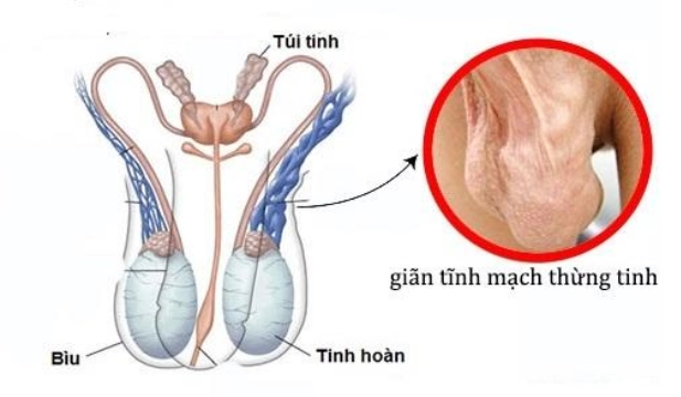 Nam giới giãn tĩnh mạch thừng tinh điều trị như thế nào?
