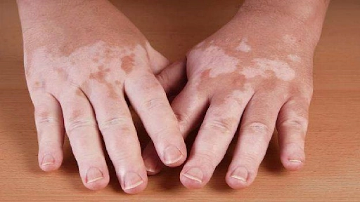 Nam giới mắc bạch biến điều trị như thế nào?