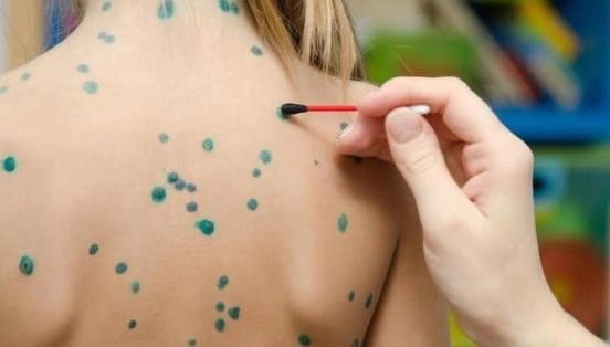 Nên dùng thuốc bôi tay chân miệng nào cho trẻ?