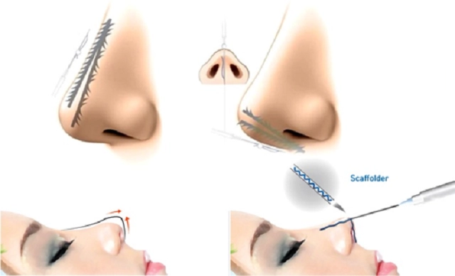 Nên nâng mũi bằng chỉ hay tiêm filler?