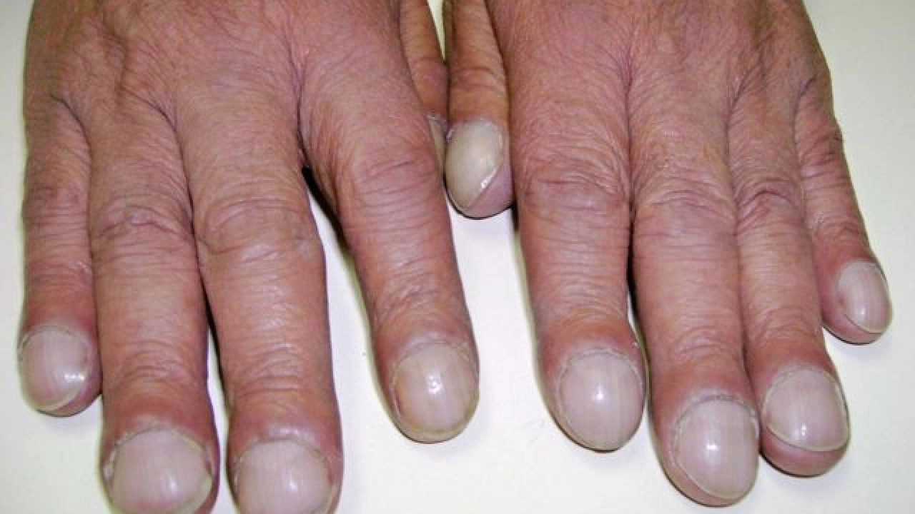 Ngón tay (chân) dùi trống và những điều cần biết