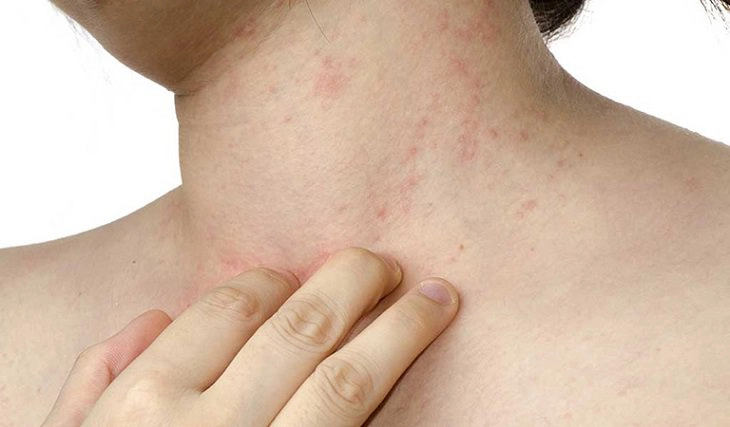 Ngứa da sau uống thuốc kháng sinh có sao không?