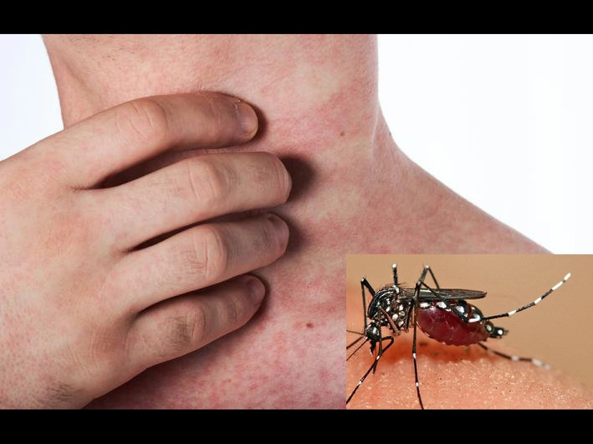 Người bị sốt xuất huyết uống thuốc gì?