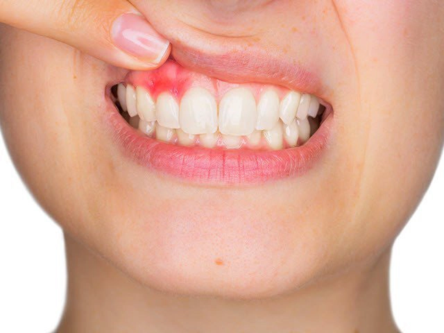 Người bị viêm lợi có nên lấy cao răng thường xuyên không?