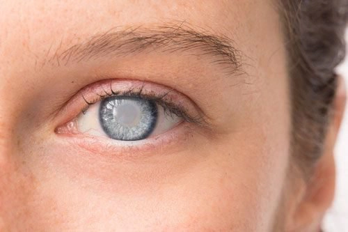 Người đục thủy tinh thể đeo được kính nào?