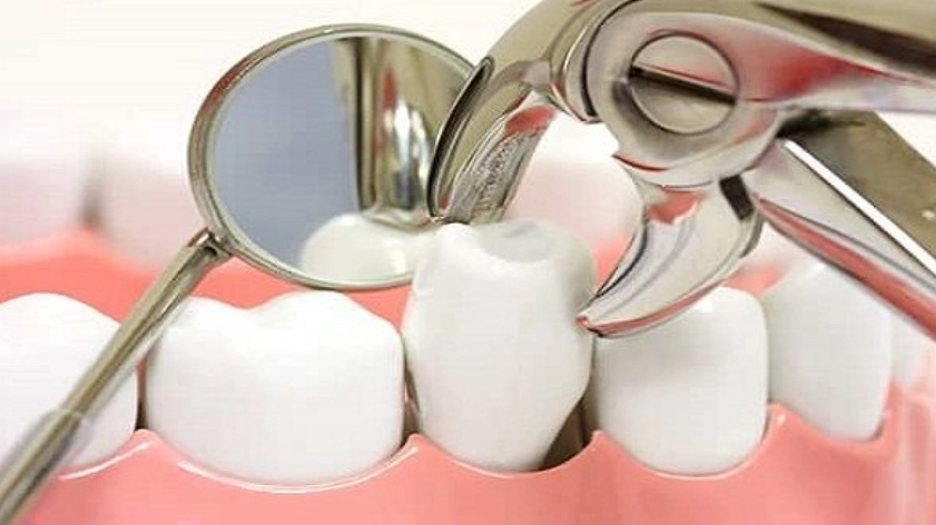 Người trưởng thành nhổ răng có giảm tuổi thọ không?