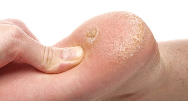 Nguyên nhân các loại mụn cóc khác nhau
