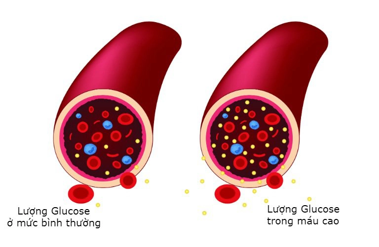 Nguyên nhân khiến đường huyết không ổn định