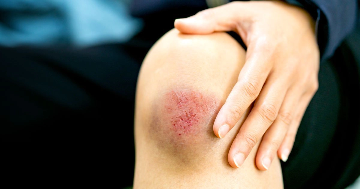 Nguyên nhân khiến vết thương sưng tấy