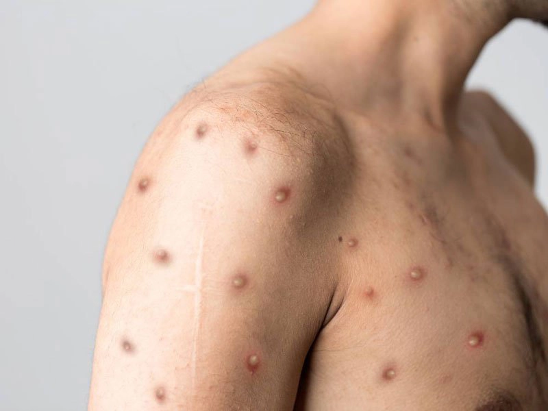 Nhận biết bệnh đậu mùa khỉ qua hình ảnh