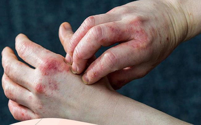 Nhận diện các bệnh da do đái tháo đường