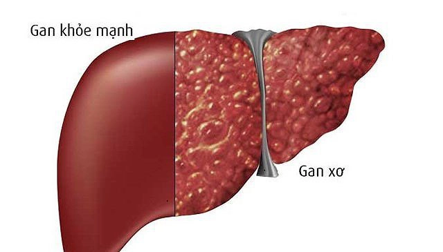 Nhiễm Covid-19 ở bệnh nhân xơ gan