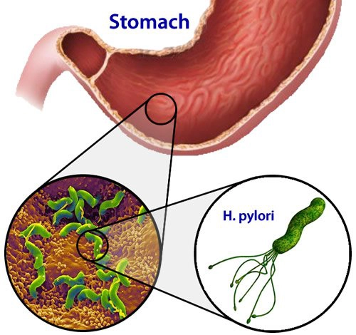 Nhiễm Helicobacter pylori và các biểu hiện ở ngoài dạ dày