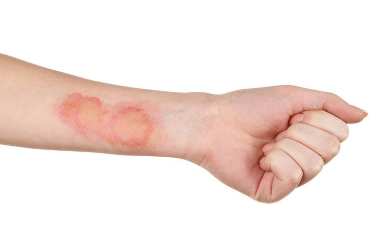 Nhiễm trùng da: Những điều bạn nên biết