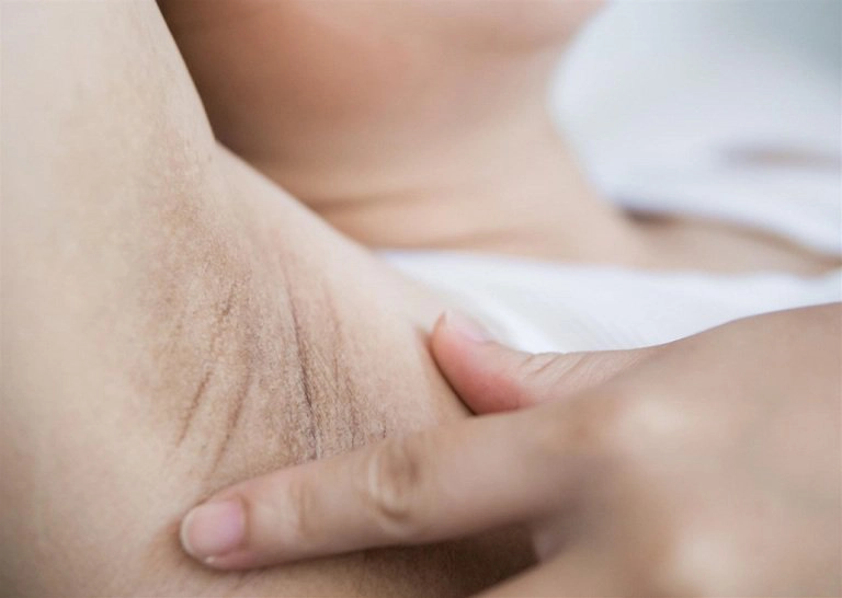 Nhổ lông nách có gây viêm lỗ chân lông?
