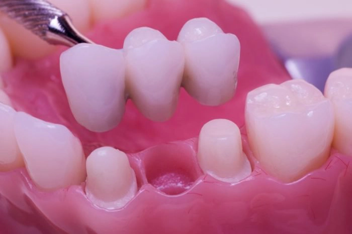Nhổ răng rồi có nên trồng lại không?